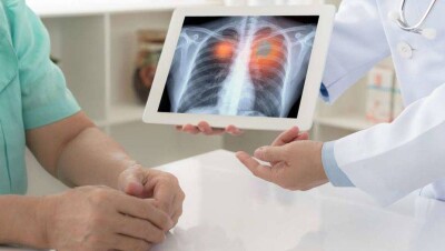 В Алматы можно пройти бесплатное обследование на рак лёгкого