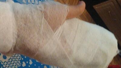 Фаланги пальцев отрезало школьнице в Уральске баскетбольной сеткой