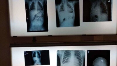 В Астане врачи спасли жизни 130 детей, проглотивших различные предметы