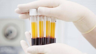 У 90% пациентов, которые получали лечение иммунной плазмой, состояние улучшилось