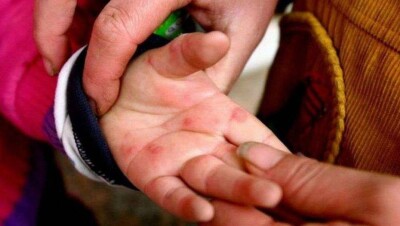 Вирус Коксаки подхватили казахстанцы, отдыхающие в Турции – СМИ