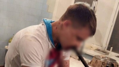 Жителя Карагандинской области, в рот которого вонзилась арматура, выписали из больницы