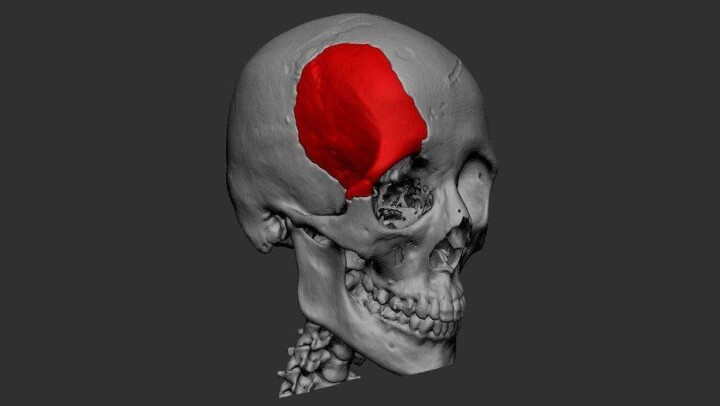 В Алматы врачи установили пациентке 3D-печатную пластину в череп и спасли ей жизнь