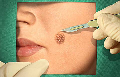 Родинки и веснушки могут скрыть от вас рак
