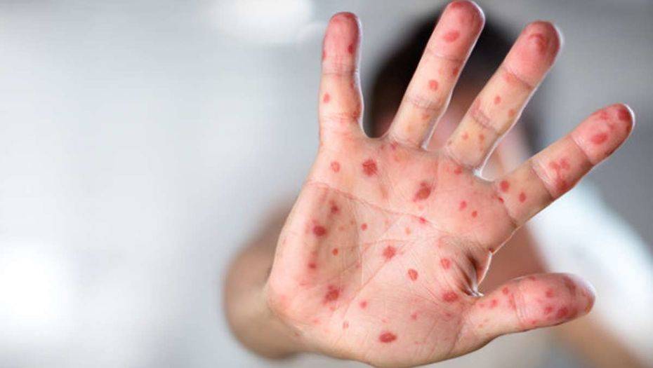 В Акмолинской области десятки детей заболели корью