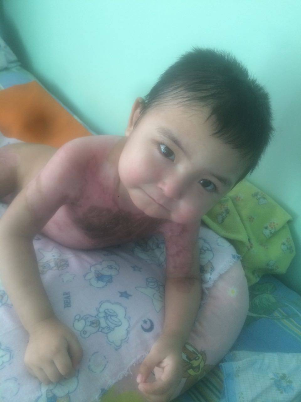 Трёхлетний мальчик идёт на поправку после сильнейшего ожога