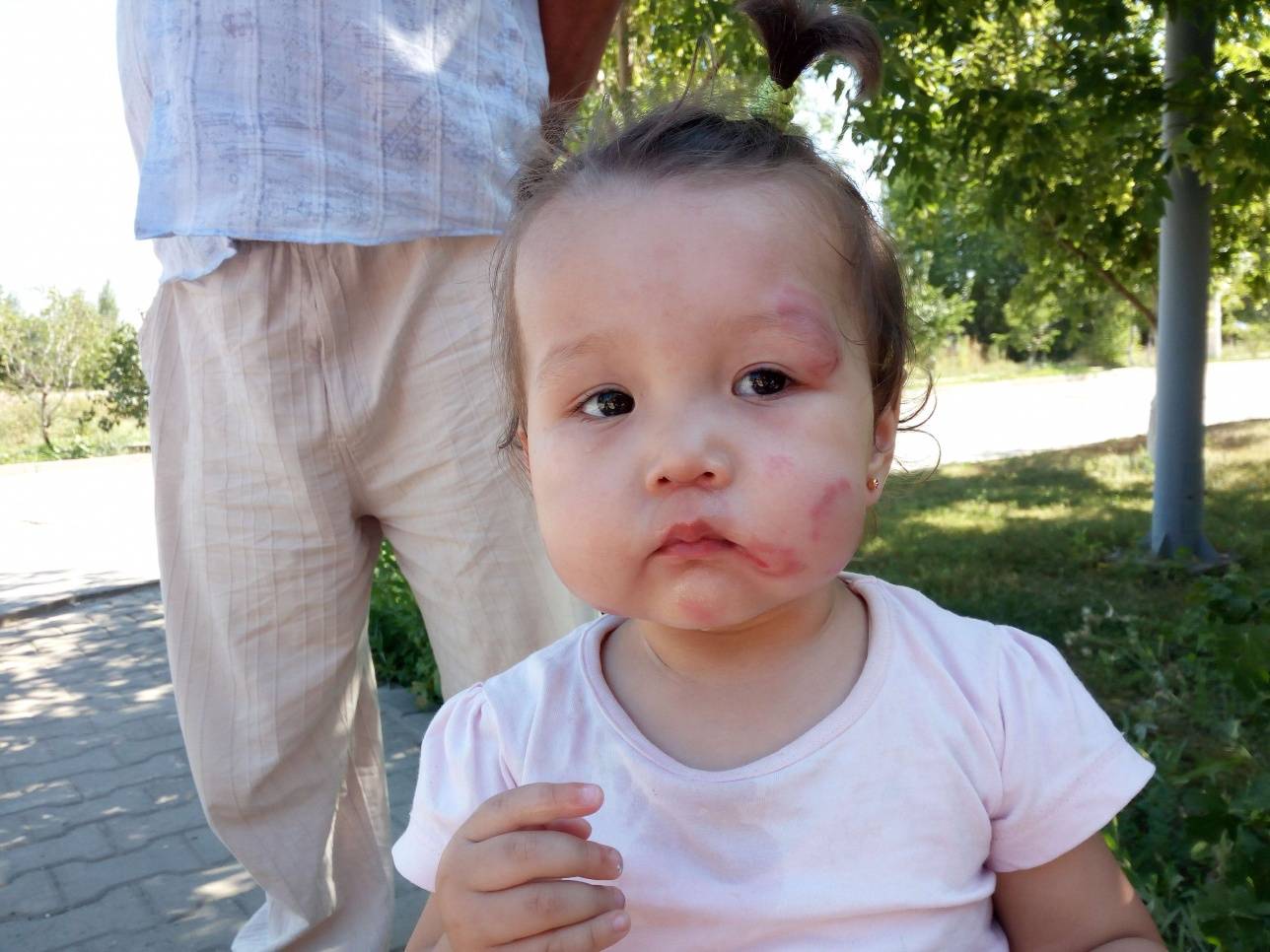 У маленькой Дильназ оказались искусанными лицо и тело